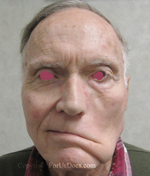 Bell Palsy Disease